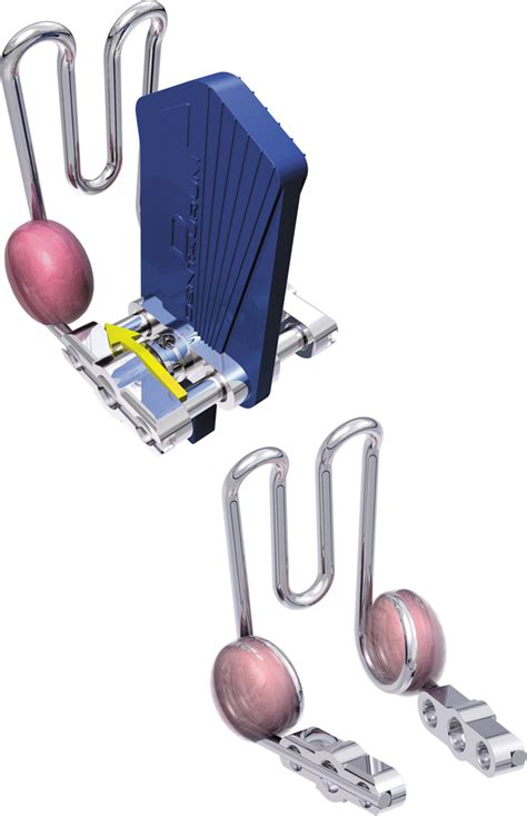 Guide Ridge For Flexible Forward Thrust Double Plate System Acc To