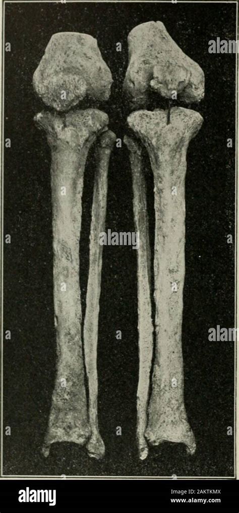 Tertiary Syphilis Hi Res Stock Photography And Images Alamy