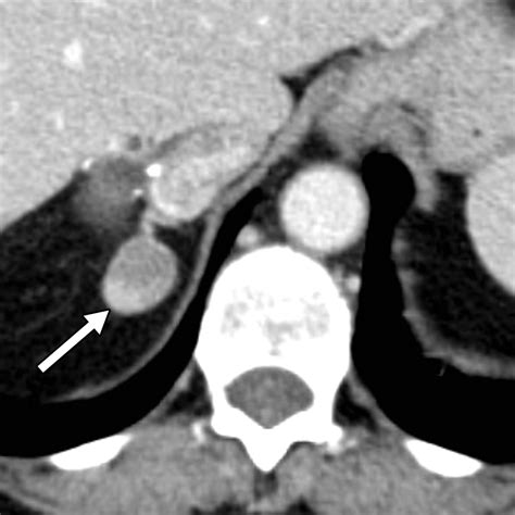 Adrenal Imaging Why When What And How Part 1 Why And When To