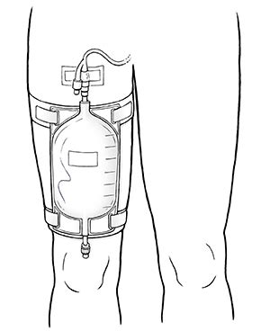 Discharge Instructions Caring For Your Leg Bag Saint Luke S Health