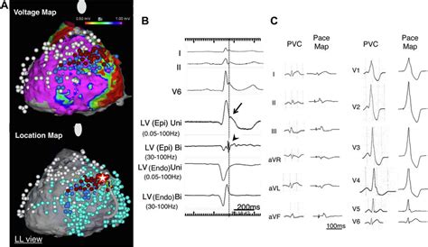 A Epicardial Bipolar Voltage Upper And Location Map Lower Of The