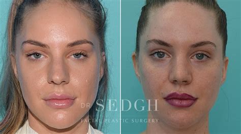 Crooked Nose Surgery Before And After Photos Dr Sedgh