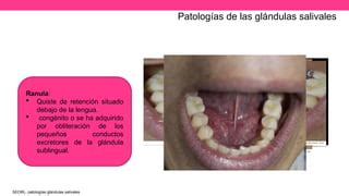 Tumores Y Patologias De Glandulas Salivales Pptx