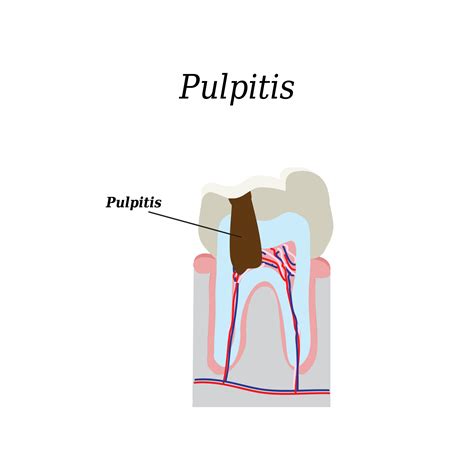 pulpitis types  symptoms treatment