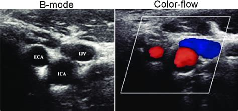 Transverse B Mode And Color Flow Imaging Of Carotid Artery Obtained At