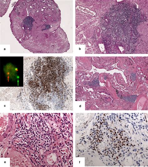 Incidence Of Preclinical Manifestations Of Mantle Cell Lymphoma And Mantle Cell Lymphoma In Situ