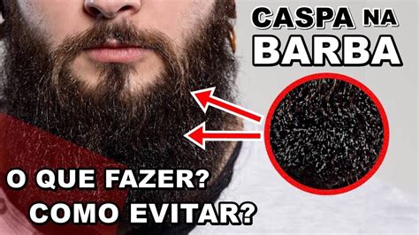 Caspa Na Barba Como Evitar E Tratar Este Problema Youtube