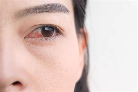 7 Pink Eye Symptoms You Shouldn't Ignore | The Healthy