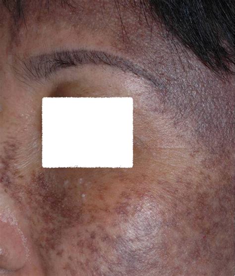 Nevus Of Ota Oculodermal Melanosis Dermatology Advisor