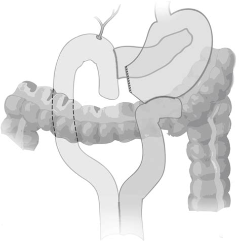 Pancreatico Enteric Fistula Post Pancreatic Duct Ligation For Delayed