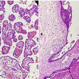 Cytotrophoblast and syncytiotrophoblastcell-lined fragments of ...