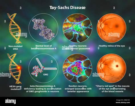 Illustration Of Tay Sachs Disease A Genetic Disorder That