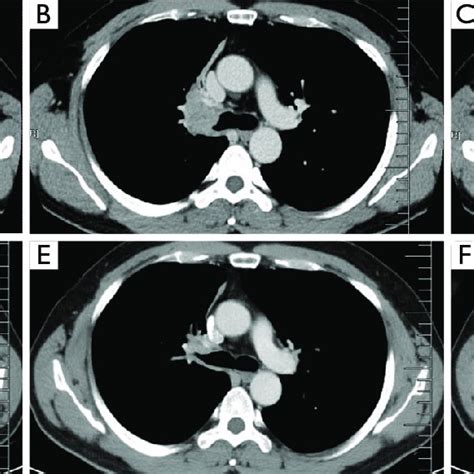 Chest Ct Before Abc And After Neoadjuvant Chemotherapy Def Download Scientific Diagram