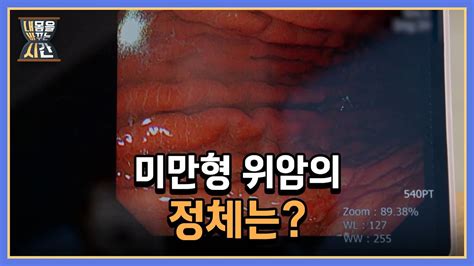 여성에게 더 위험한 위암 미만형 위암의 정체는 MBN 220828 방송 YouTube