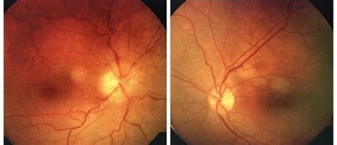 Optic disc edema in right fundus and normal apperence of left optic ...