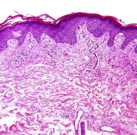 Primary cutaneous T cell lymphoma mycosis fungoides and Sézary