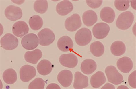 A Howell–Jolly body (marked by arrow) on peripheral blood smear (red ...