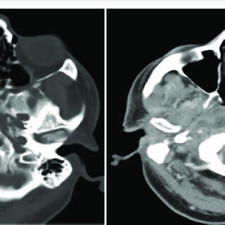 Repeat axial CT scan showing bony erosion around the clivus and foramen ...