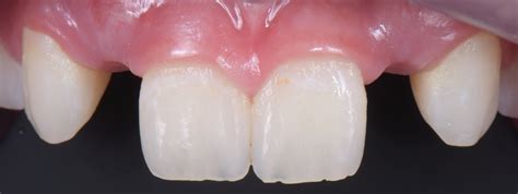 Three Solutions For Congenitally Missing Lateral Incisors Spear Education