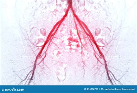 Femoral Artery Angiogram Or Angiography Stock Image Image Of