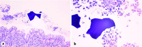 Sigmoid Colon Biopsy A Mucosal Injury With Intraepithelial Download Scientific Diagram