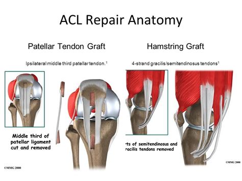 Patellar Tendon Graft