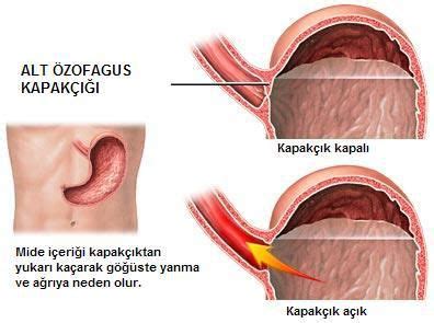 Refl Nedir Refl N N Belirtileri Ve Tedavisi Nas L Ndigo Dergisi