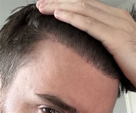 Finasteride Minoxidil For 1 5 Years And Then Only Minoxidil R Hairtransplants