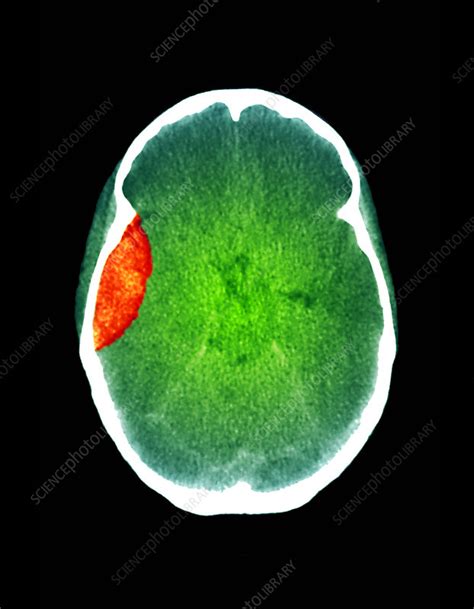 Brain Haemorrhage Ct Scan Stock Image M1360203 Science Photo