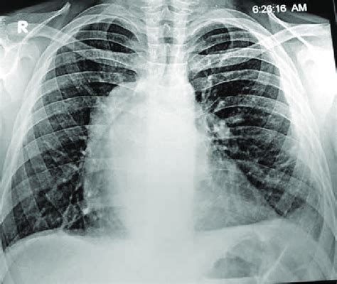 Chest X Ray Pa View Showing Calcific Left Ventricular Aneurysm Arrows