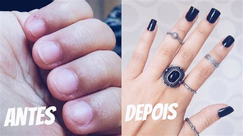 Como Parar De Roer As Unhas Youtube