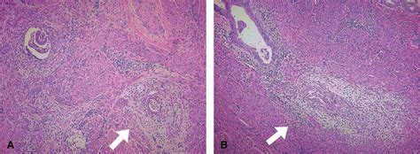 MELF Pattern Invasion In Endometrial Carcinoma Association With Low