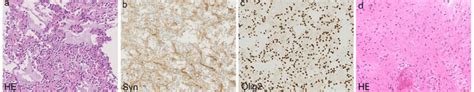 Morphological And Immunohistochemical Features Of Rosetteforming