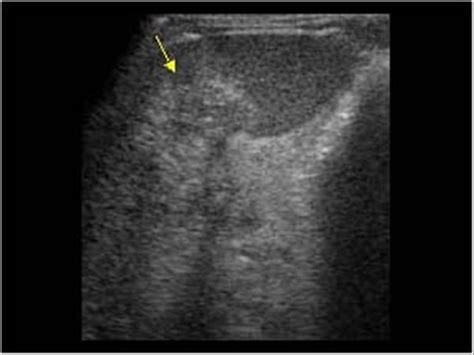 Wk 5 Spleen Pathology Splenic And Liver Metastases With A Hyperechoic