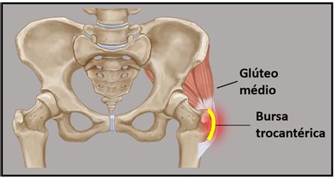 Bursite Trocant Rica O Que Causa Diagn Stico E Tratamento