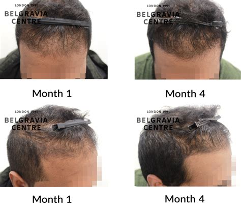 Hair Loss Success Story I M Incredibly Pleased With The Results So Far