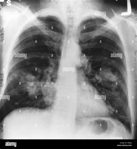 Lung Cancer Chest X Ray Stock Photo Alamy