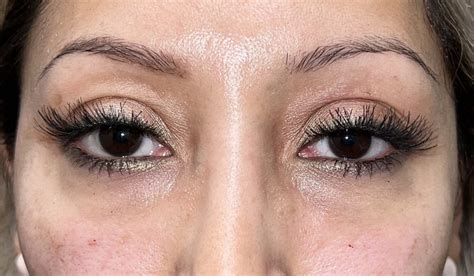 5 Eyelid Filler Before And After Photos Dallas Plano Texas Cosmetic Reconstructive Eye Surgery