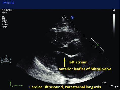 Cardiac Ultrasound Parasternal Long Axis View Demonstrating Abnormal