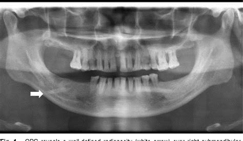 Figure 1 From A Rare Case Of Large Submandibular Sialolith With