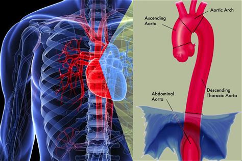 Aorta Artery Aneurysm