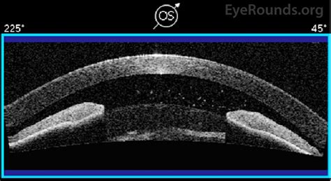 Atlas Entry Phacomorphic Angle Closure And Anterior Lens Dislocation