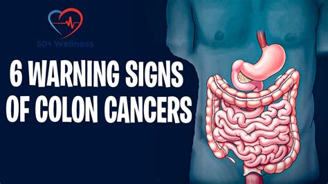 6 Warning Signs Of Colon Cancer Youtube