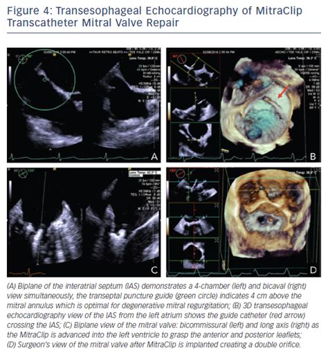 Figure 4 Transesophageal Echocardiography Of Mitraclip Transcatheter