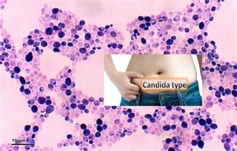 Candida Gut Type Healthylife Werindia