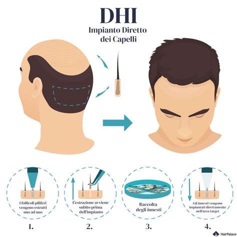 Trapianto Di Capelli Dhi Procedura Come Funziona E Costi