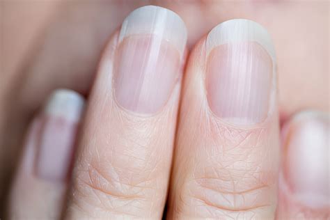 Tout Savoir Sur Les Ongles Stri S Causes Et Solutions