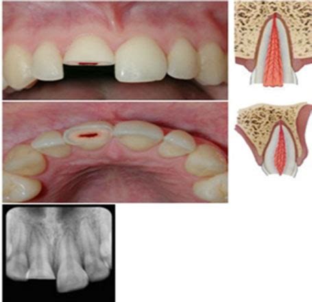 Types Of Teeth Fractures