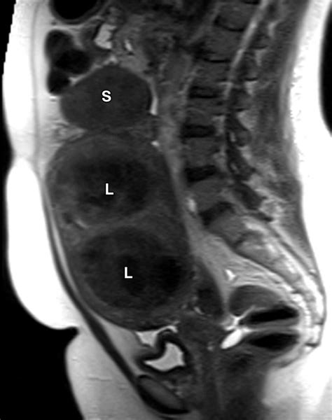 Role Of Mr Imaging Of Uterine Leiomyomas Before And After Embolization