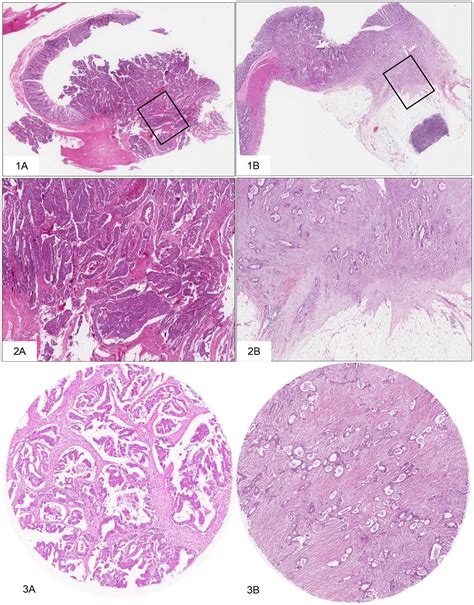 Standardized Assessment Of The Tumor Stroma Ratio In Colorectal Cancer